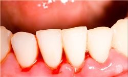 خونریزی لثه نشانه چیست؟ خونریزی لثه نشانه چیست؟