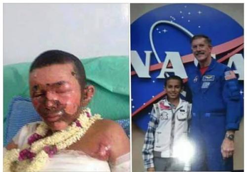 سعودی‌ها کودک یمنی برنده جایزه ناسا را سوزاندند!+عکس 