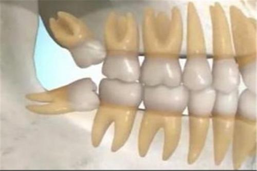 علائم عفونت دندان 
