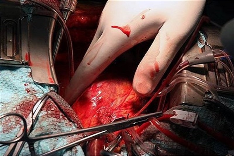 نادرترین عمل جراحی قلب جنین خاورمیانه در شیراز انجام شد