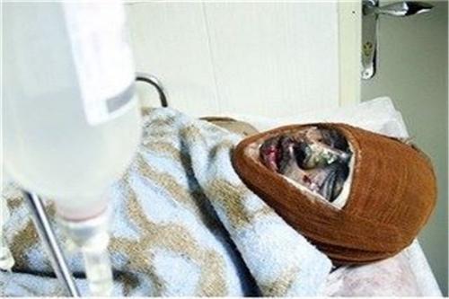 روزی ۱۰ بیمار سوختگی در ایران می‌میرند