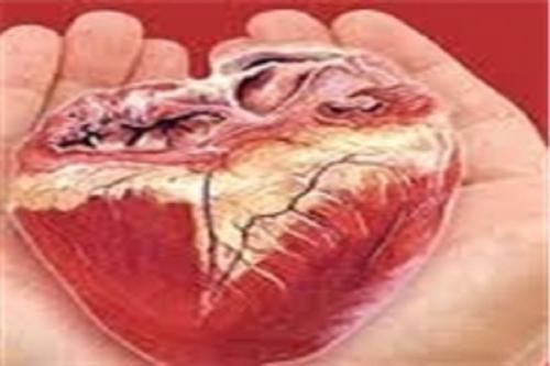 گرفتگی عروق شایع‌ترین علت نارسایی قلب است