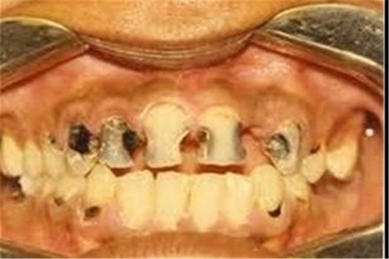 یک قرن تلاش برای دستیابی به دندان‌های روشن‌/ دندان سفید کنیم یا نکنیم
