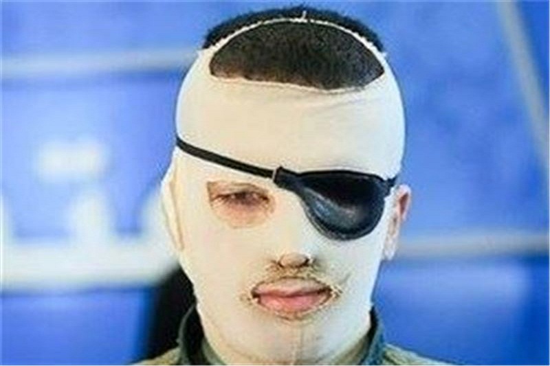 جزئیات مختومه شدن دومین پرونده جنجالی اسیدپاشی