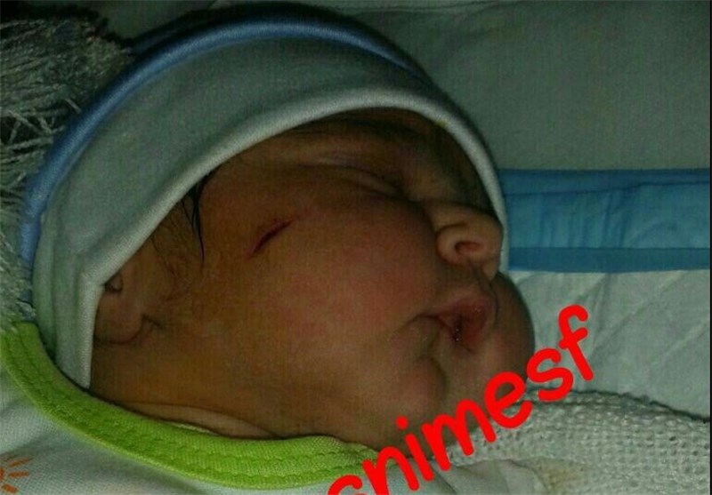 عکسی که بار دیگر جامعه پزشکی اصفهان را به چالش کشید/ واقعیت ماجرای بریدگی گونه نوزاد اصفهانی چیست؟! 