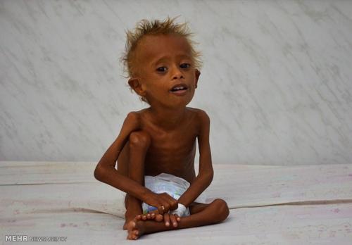 بیش از یک میلیون کودک یمنی با گرسنگی شدید روبرو هستند