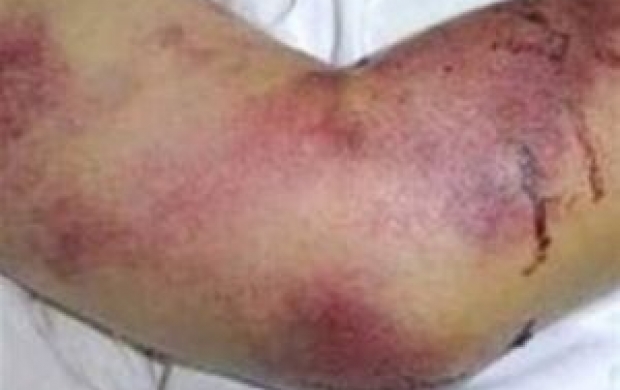 ۳ نفر در فارس مبتلا به تب کریمه شدند