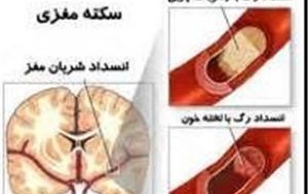 علت ۳۰۰ سکته مغزی روزانه در ایران