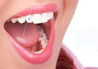  ایمپلنت دندان و عوارض آن را بشناسیم