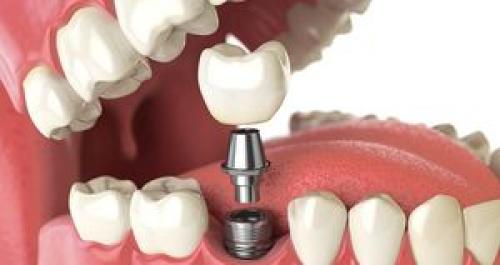 نکته‌ای که عمر ایمپلنت دندان را افزایش می‌دهد