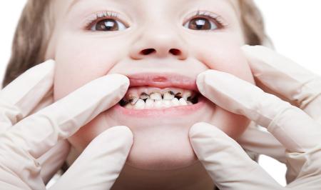 عوامل موثر در پوسیدگی دندان بچه‌ها