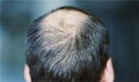 ریزش ۱۰۰ تار مو در روز طبیعی است/ اختلالات هورمونی اصلی‌ترین عامل ریزش مو