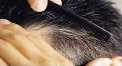 درمان قطعی ریزش مو با استفاده از PRP