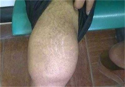سنگلاخ‌های حقوقی قدیمی‌ترین پرونده بیماران ایرانی