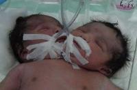 تولد نوزاد دو سر در بیمارستان بزرگ دزفول + عکس 