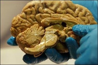 مغز معتادان دچار تغییرات ژنتیکی میشود