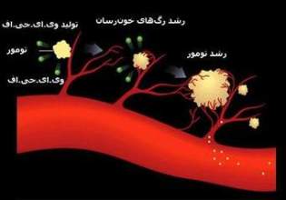 رایج ترین سرطان در بین زنان و مردان ایرانی