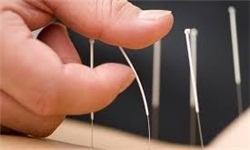 طب سوزنی، درمانی مؤثر برای چاقی، بیماریهای روانی و جایگزینی برای بوتاکس