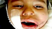 انفجار ترقه در دهان کودک3 ساله + عکس