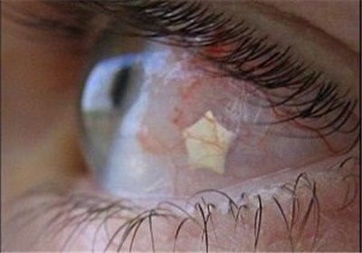  نگین‌های ممنوع اروپایی سنگفرش چشمان ایرانی