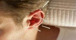 امکان درمان ناباروری با استفاده از طب سوزنی بر روی گوش