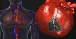 نشانه اولیه سکته قلبی چیست؟ 