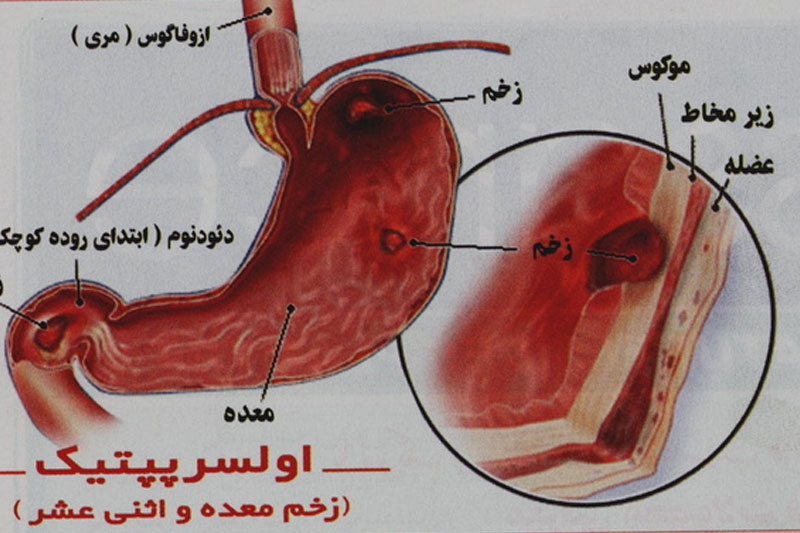 شایع‌ترین علامت زخم معده 